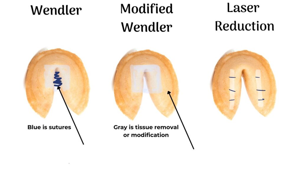 Depictions of glottoplasty techniques using fortune cookies to represent the vocal cords with the rounded part up and the points down.  In a Wendler, tissue is removed at the top of the vocal cords, near the V-fold of the cookie.  The two sides are then sutured together.  A Modified Wendler removes tissue in the same place, but uses filler or surgical glue to join the two sides.  A laser reduction glottoplasty removes tissue along the length of the "legs: of the cookie and sutures each incision.